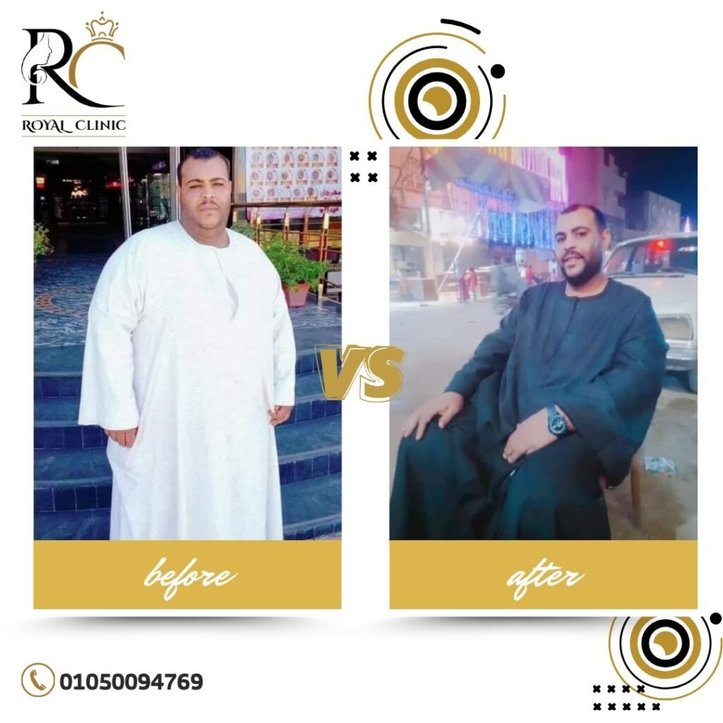 حالة قبل وبعد عملية تكميم المعدة في رويال كلينيك